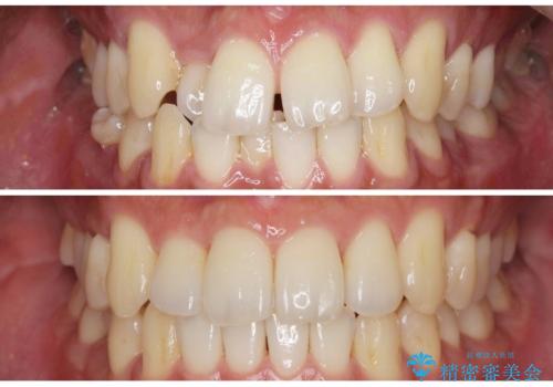 [ インビザライン矯正 ]  マウスピースで治す、すきっ歯　がたつき