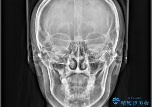 「歯を抜かずに、たった10ヵ月。」目立ちにくい大人の矯正の治療前