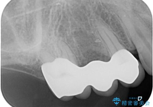 過大な力で折れた失活歯 セラミックブリッジ治療の治療後