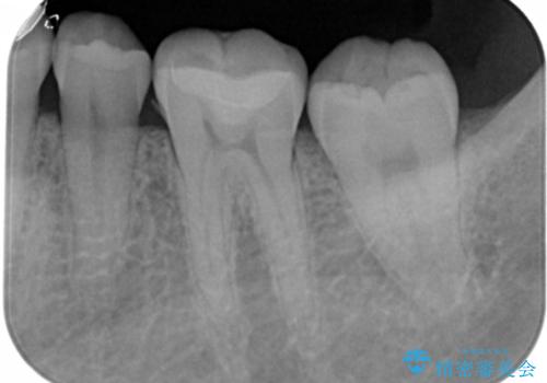奥歯にセラミックを入れたい セラミックインレーの治療後