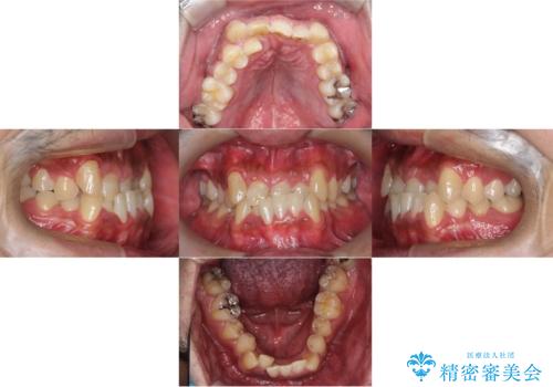 【ワイヤー矯正】かみ合わせを治したいの治療前