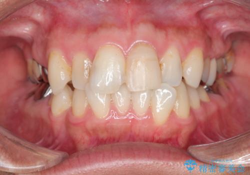 転んで折れた前歯セラミック治療で審美改善の治療中