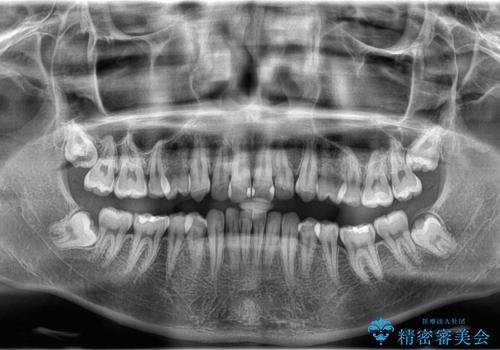 デコボコも深いかみ合わせも…“全部気になる”を一気に解決の治療前