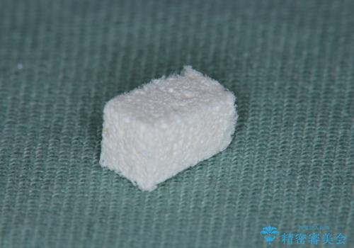 [ 全て歯を抜かなければいけないと言われた] 矯正治療を含む包括的歯周病治療