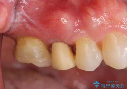 過大な力で折れた失活歯 セラミックブリッジ治療の治療前