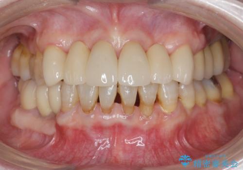 [ 全て歯を抜かなければいけないと言われた] 矯正治療を含む包括的歯周病治療の治療後