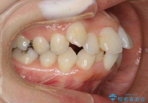 出っ歯が気になる　抜歯+ワイヤー矯正治療の治療前
