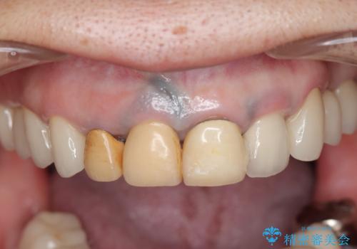 保険適応 硬質レジン前装冠から審美的でオールセラミッククラウンへの治療前