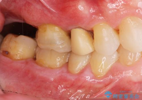 過大な力で折れた失活歯 セラミックブリッジ治療の治療前