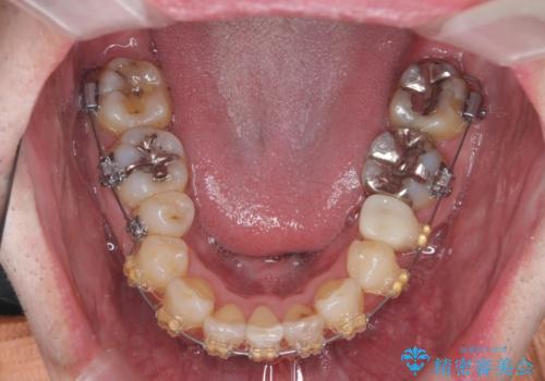 全ての銀歯を外すメタルフリー治療 + 歯並びをきれいにする矯正治療の治療中