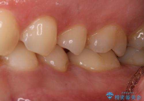 奥歯にセラミックを入れたい セラミックインレーの治療前