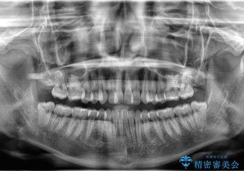 1年でここまで変わる。デコボコ歯並びの非抜歯矯正!の治療前