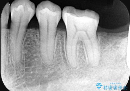 繰り返すプラスチックの欠けを解消。広範囲の修復に適したセラミッククラウンの治療前
