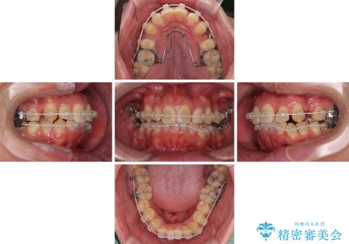狭くて前方に飛び出した歯列 拡大装置を併用したワイヤー抜歯矯正治療の治療中