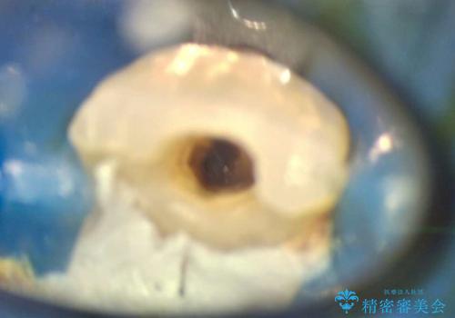 転んで折れた前歯セラミック治療で審美改善の治療前