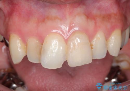 転んで折れた前歯セラミック治療で審美改善の治療中