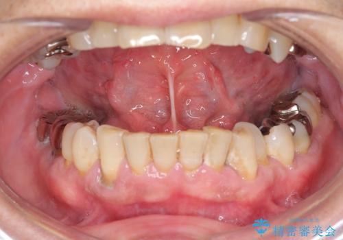 『舌小帯形成術』 ベロの動きを良くして滑舌を改善したいの治療前