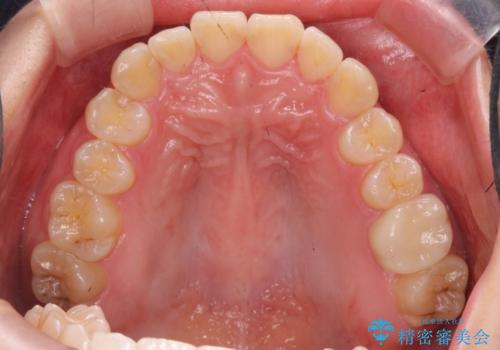 [ インビザラインライト ]  短期間で行う前歯のマウスピース治療の治療後