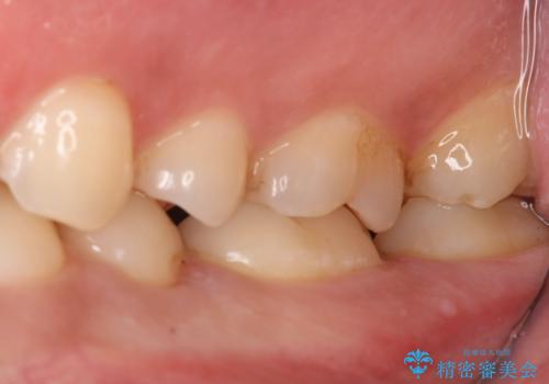 奥歯にセラミックを入れたい　セラミックインレーの治療中