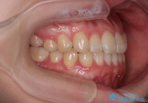 [ インビザラインライト ]  短期間で行う前歯のマウスピース治療