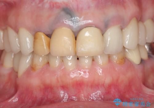 保険適応 硬質レジン前装冠から審美的でオールセラミッククラウンへの治療前