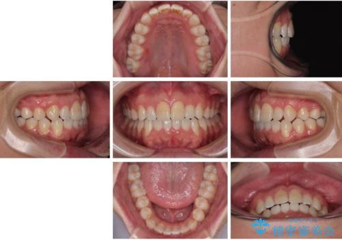 マウスピース矯正と迷った結果…管理のしやすさで選んだクリアブラケット矯正の症例の治療後
