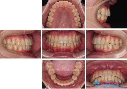 下顎の叢生を抜歯矯正で改善|費用を抑えたメタルブラケット矯正の治療後