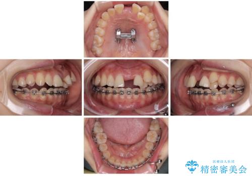 急速拡大装置　狭い上顎歯列を改善して、八重歯を改善した片側抜歯矯正治療の治療中