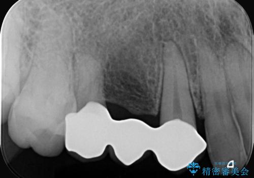 【セラミッククラウン】歯が欠けた!の治療後