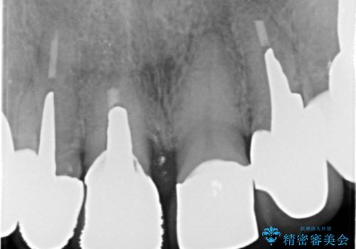 保険適応 硬質レジン前装冠から審美的でオールセラミッククラウンへの治療前