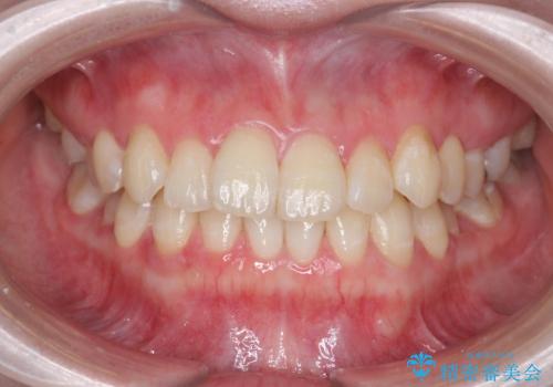 [ インビザラインライト ]  短期間で行う前歯のマウスピース治療の治療前