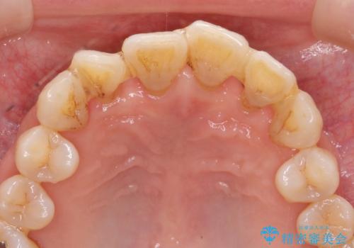 [ 全て歯を抜かなければいけないと言われた] 矯正治療を含む包括的歯周病治療の治療前
