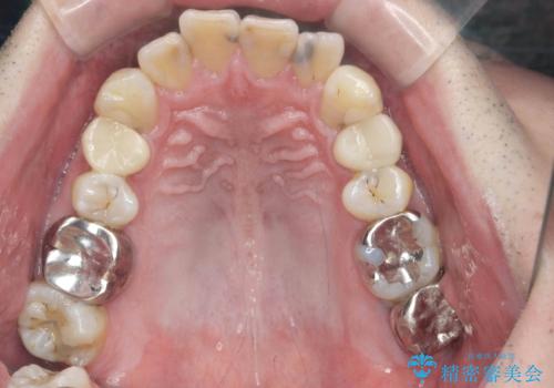 全ての銀歯を外すメタルフリー治療 + 歯並びをきれいにする矯正治療の治療前