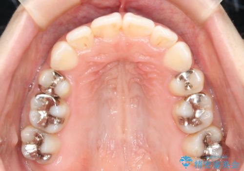 出っ歯が気になる　抜歯+ワイヤー矯正治療の治療後