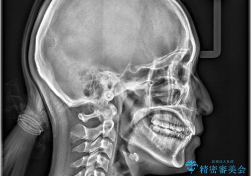 1年でここまで変わる。デコボコ歯並びの非抜歯矯正!の治療後