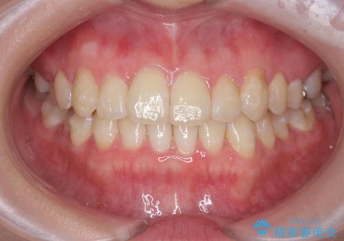 [ インビザラインライト ]  短期間で行う前歯のマウスピース治療の治療中