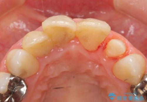 [ ジルコニアセラミッククラウン] 神経の死んだ前歯の治療の治療中