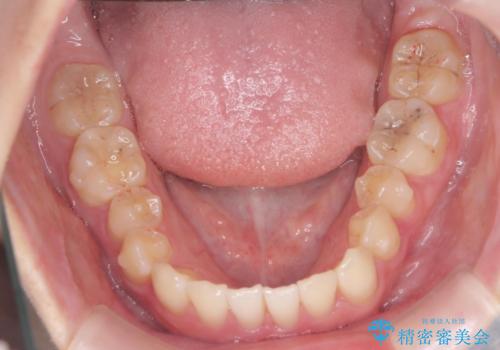 [ インビザラインライト ]  短期間で行う前歯のマウスピース治療の治療中