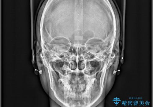 1年でここまで変わる。デコボコ歯並びの非抜歯矯正!の治療前