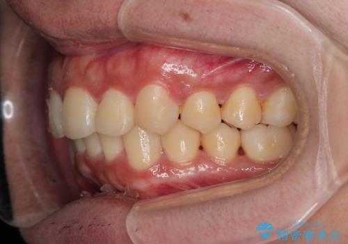 がたつきが気になる。インビザラインでスッキリ。の治療後