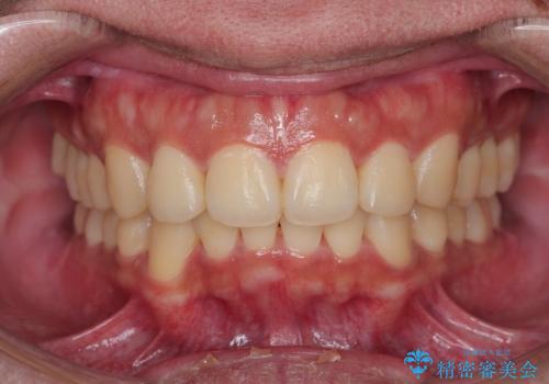 がたつきが気になる。インビザラインでスッキリ。の治療後