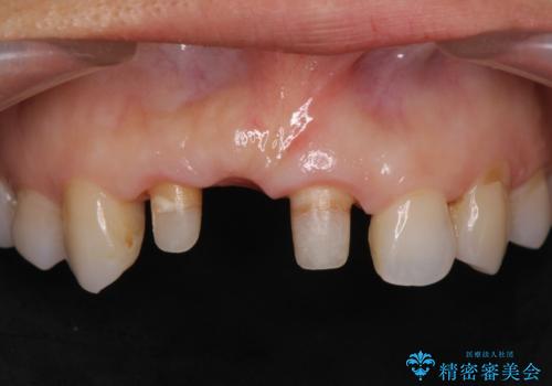 外れやすい前歯のブリッジ しっかりとした治療を受けたいの治療中