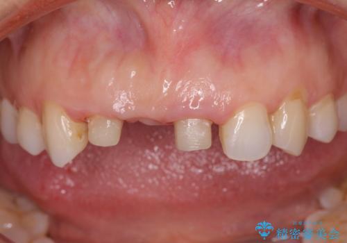 外れやすい前歯のブリッジ　しっかりとした治療を受けたいの治療中