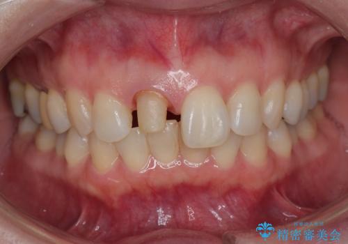 前歯の色が気になる。の治療中