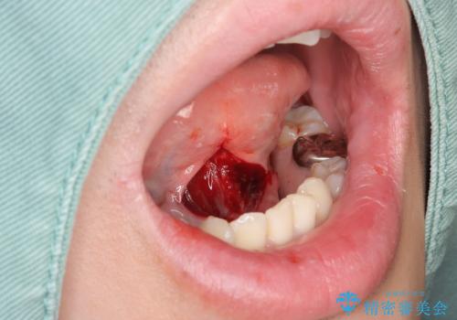 舌の動きを改善する舌小帯形成術の治療中