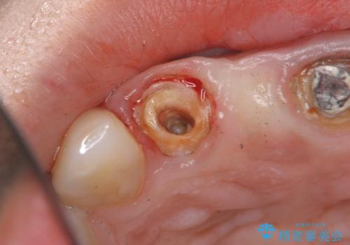 外れやすい前歯のブリッジ　しっかりとした治療を受けたいの治療前