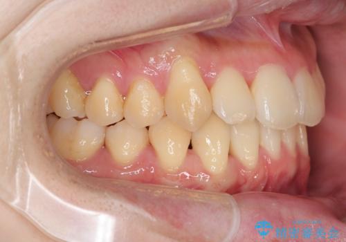 ねじれ・がたつきのある前歯を改善の治療後