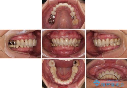 【海外から通院】統一感のない前歯をきれいに　オールセラミッククラウン治療の治療後