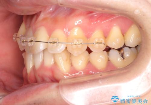 ねじれ・がたつきのある前歯を改善の治療中