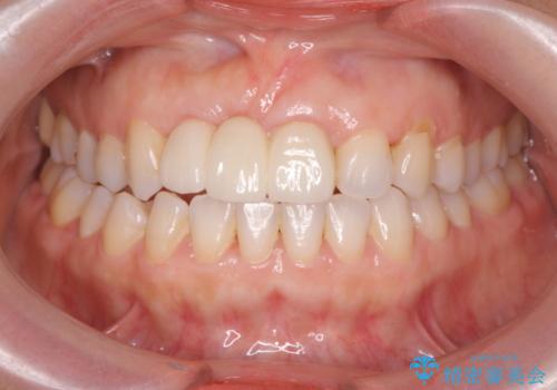 外れやすい前歯のブリッジ しっかりとした治療を受けたいの治療後